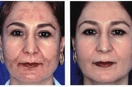 Glycolic Peel Treatment 5 Best-Glycolic-peel-treatment-in-Abu-Dhabi-Al-Ain