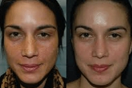 Best-Glycolic-peel-treatment-in-Abu-Dhabi