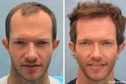 Best-Hair-Implants-Clinic-in-Abu-Dhabi