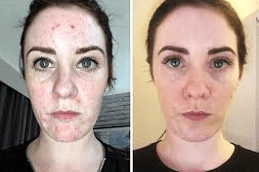 Hyaluronic Acid 5 Best-Hyaluronic-Acid-Injections-in-Abu-Dhabi