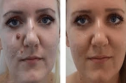 Best-Laser-Birthmark-Removal-in-Abu-Dhabi-Al-Ain