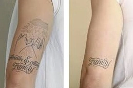 Best Laser Tatto Removal in Abu Dhabi