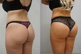 Best Non Surgical Bum Lift Clinic in Abu Dhabi Al Ain