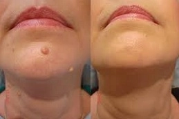 Skin Tag Removal 8 Best-Skin-Tag-Removal-in-Abu-Dhabi-Al-Ain