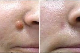 Best-Skin-Tag-Removal-in-Abu-Dhabi