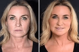 Best-Sugar-Thread-Lift-in-Abu-Dhabi-Al-Ain