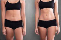 Body Contouring Treatment 8 Body Countring in Abu Dhabi & Al Ain