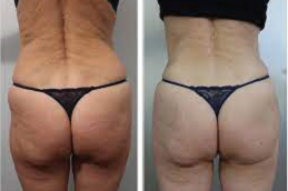 Body Fillers - Butt Fillers 8 Body Fillers in Abu Dhabi