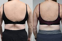 Bra Line Lift in Abu Dhabi