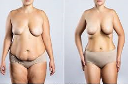 Breast Reconstruction Clinic in UAE