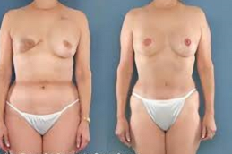 Breast Recosntruction in Abu Dhabi