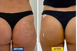 Butt Fillers in Abu Dhabi