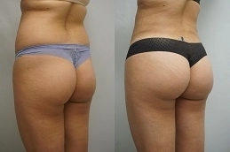 Buttock-Lift-in-Abu-Dhabi-Before-After