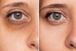 Dark Circles Treatment Abu Dhabi 5 Dark-Circle-Treatments-in-Abu-Dhabi-Al-Ain