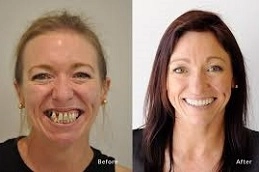 Dental-Implants-in-Abu-Dhabi-Al-Ain.