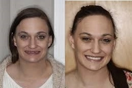 Dental-Implants-in-Abu-Dhabi