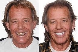 Dental Implants 5 Dental-Implants