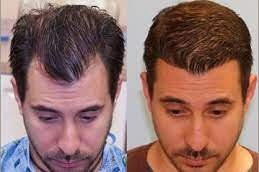 Front Line Hair Fixing 8 Front line hair fixing