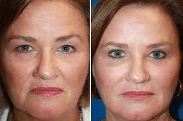 Glycolic-peel-treatment-in-Abu-Dhabi