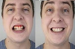 Gum Bleeding Treatment 5 Gum-Bleeding-Treatment