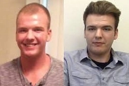 Hair-Implants-in-Abu-Dhabi-Al-Ain