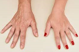 Hand Rejuvenation 6 Hand Rejuvenation IN Abu Dhabi