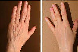 Hand Rejuvenation 7 Hand Rejuvenation