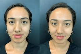 Hyaluronic Acid 3 Hyaluronic-Acid-Injections-in-Abu-Dhabi-Al-Ain