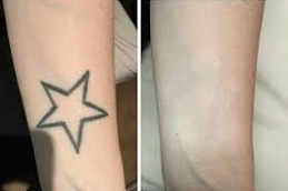 Laser Tattoo Removal in Abu Dhabi UAE