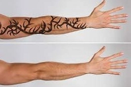 Laser Tattoo Removal