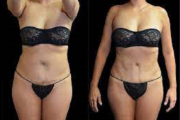 11 Best Clinics for Liposuction in Beirut [2023 Prices]