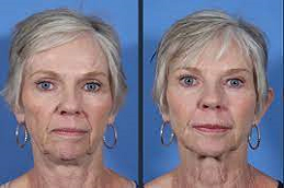 Liquid Facelift in Abu Dhabi