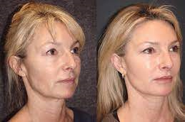 Magic Facelift Clinic