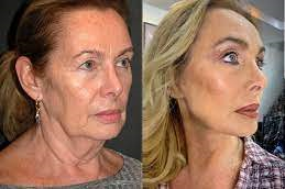 Magic Facelift in Abu Dhabi