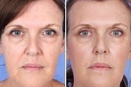 Microneedling PRP Therapy Clinic in UAE