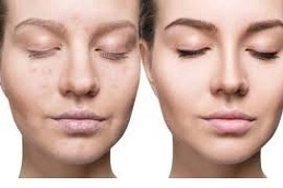 Microneedling PRP Therapy Ttreatment in Abu Dhabi