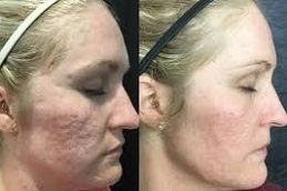 Microneedling With PRP in UAE