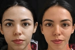 Microneedling-for-Acne-Scars-in-Abu-Dhabi-Al-Ain