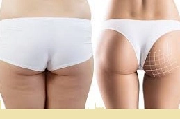 Non surgical bum lift