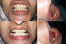 Polishing-Scaling-Treatment-in-Abu-Dhabi-Al-Ain