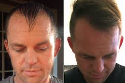 Robotic Hair Transplant 5 Robotic Hair Transplant Clinic