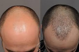 Scarless Hair Transplant 5 Scarless Hair Transplant