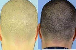 Scarless Hair Transplant 3 Scarless Hair Transplant in Dubai & Al Ain