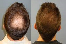 Scarless Hair Transplant 4 Scarless Hair Transplant in UAE