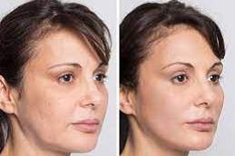 Silhouette Lift in Abu Dhabi