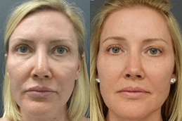 Stem-Cell-Facelift-in-Abu-Dhabi-before-after