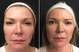 Sugar-Thread-Lift-Clinic-in-Abu-Dhabi-Al-Ain