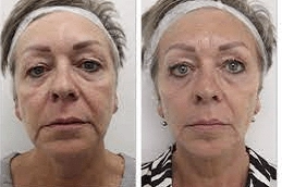 Sugar-Thread-Lift-in-Abu-Dhabi-Al-Ain