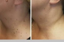 Tag-Removal-From-Skin-in-Abu-Dhabi