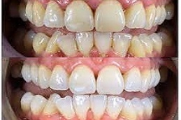 Teeth Cleaning 5 Teeth-Cleaning